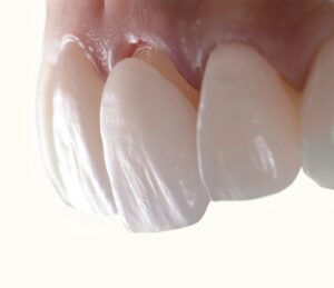 How Do Veneers Affect Oral Health?