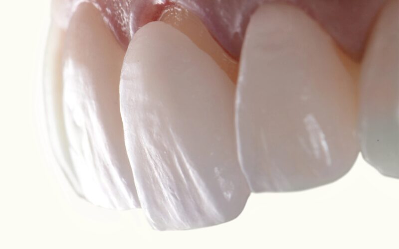 How Do Veneers Affect Oral Health?